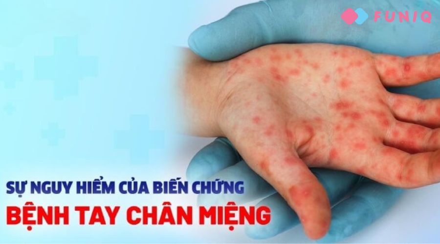 Tay chân miệng biến chứng khi nào đi viện